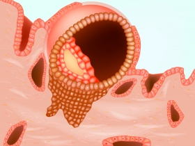 What is EmbryoGlue and How It Can Affect Your IVF Outcome 